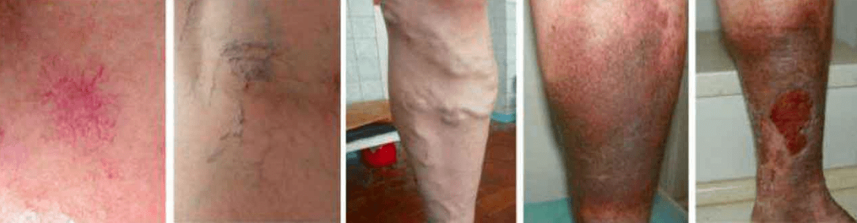 Etape ale varicelor pe picioare