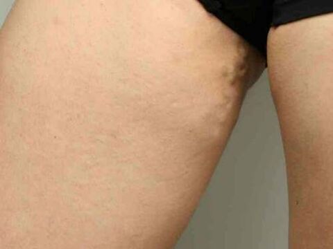 vene varicoase ale pelvisului în timpul sarcinii